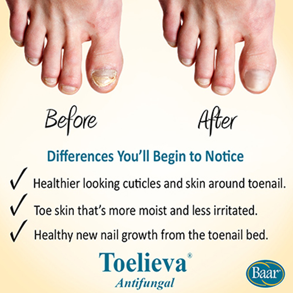 Toelieva before and after toenail images